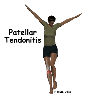 Patellar Tendonitis of the Knee