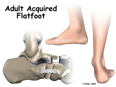 Adult Acquired Flatfoot Deformity
